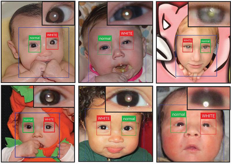CRADLE: The app that detects eye diseases and saves many babies 2 CRADLE babies