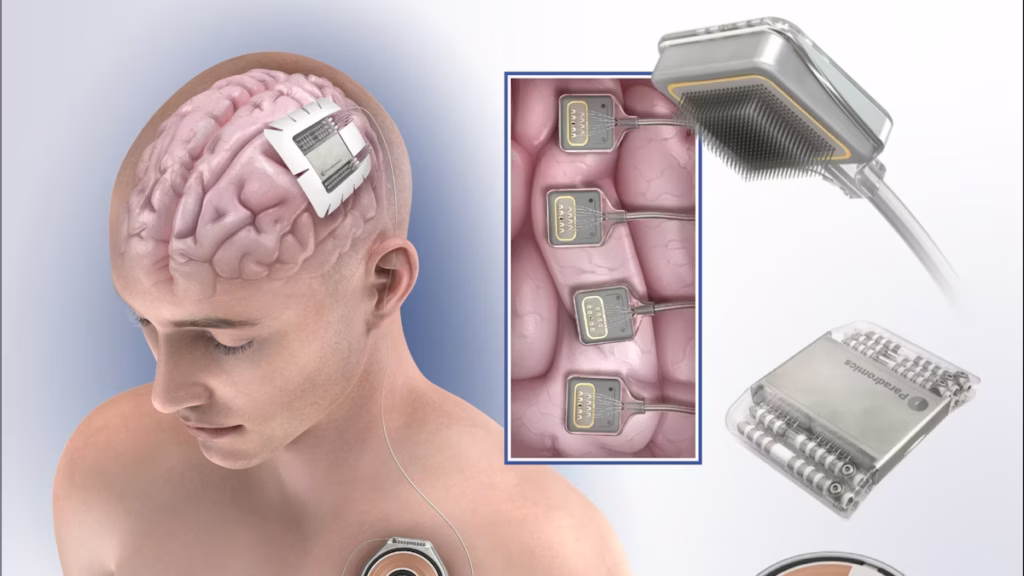 Paradromics: The first implantation of BCI technology in a human 1 Paradromics: The first implantation of BCI technology in a human